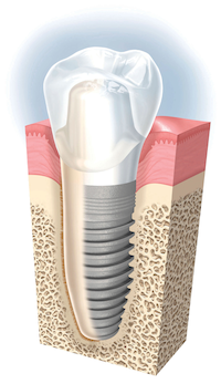implante dental