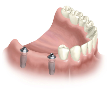 puente sobre implantes