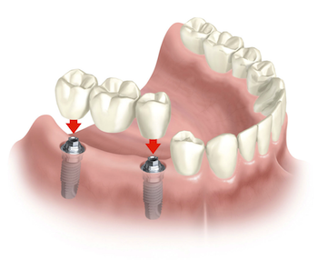 Puente sobre implantes