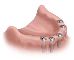 Desdentado implantes