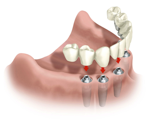 Desdentado implantes