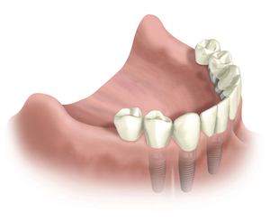 Rehabilitación total con implantes en un desdentado